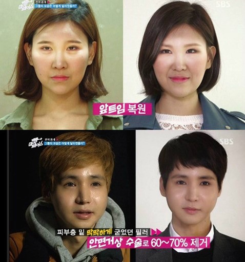 '백투마이페이스'에서 출연자들이 복원 수술을 결심했다. ⓒ SBS 방송화면 캡처