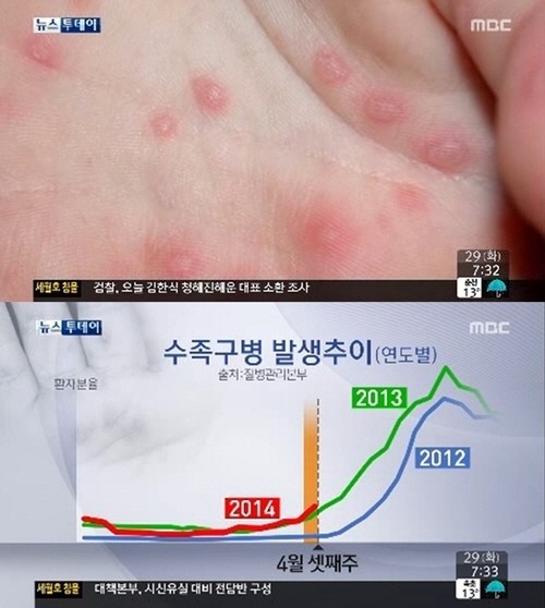 수족구병 예방법에 관한 관심이 높다. ⓒ MBC 화면 캡처