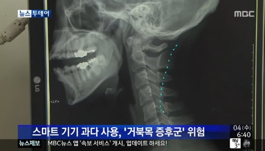 거북목 증후군에 대한 관심이 급증했다. ⓒ MBC 방송화면