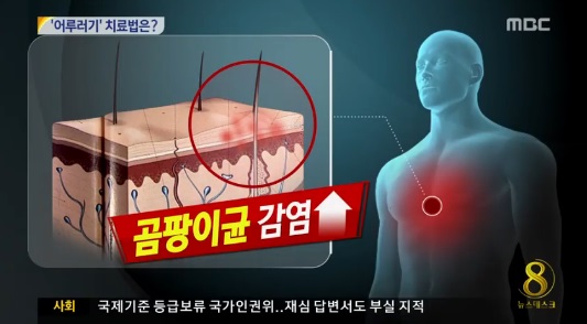 여름철 어루러기 주의 ⓒ MBC