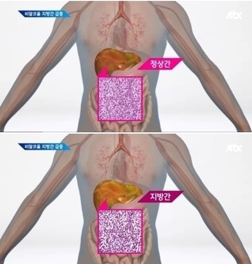 지방간 예방법 ⓒ JTBC