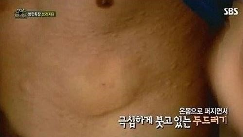 한랭두드러기 특징 ⓒ SBS