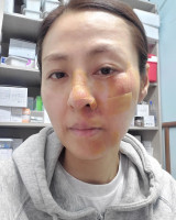 전혜진, 피+진물 범벅된 얼굴…쇠파이프 뿌리에 걸려 넘어져 충격 