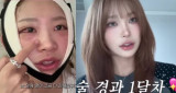 중안부 짧은 미모 대세 속…최준희, 윤곽 한달차 뼈 안치고 돌려서 중안부 짧게 만들어