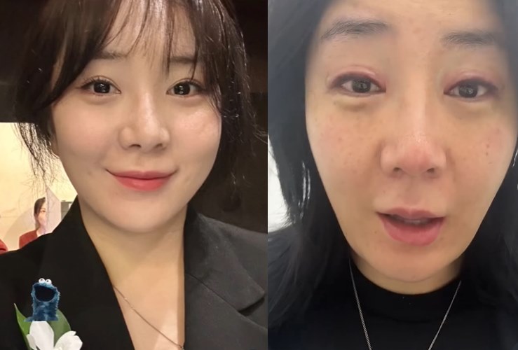 허안나가 아이라인 제거 수술을 받은 모습을 공개했다. 사진=허안나 SNS