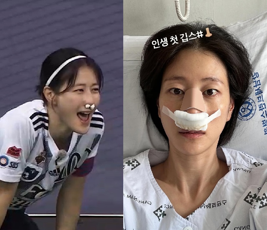 코뼈 골절 부상을 당한 이현이.