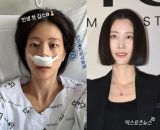 이현이, '안면 마비' 2년만 '코뼈 골절' 대형 부상…"의욕 앞서, 다행히 회복"
