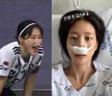 '안면마비 고백' 이현이, 안구 이어 코뼈 골절…입원에 부상 순간 재조명 [엑's 이슈]