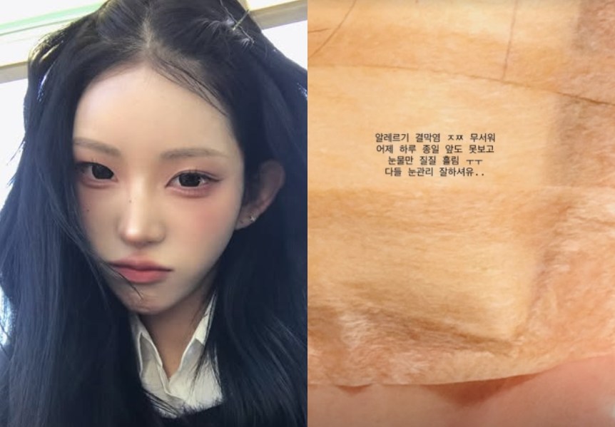 최준희가 알레르기성 결막염을 앓고 있는 사진을 공개했다