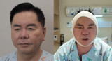 심형래, 얼굴 뜯어고쳤다…'안면거상' 재수술 현장 공개