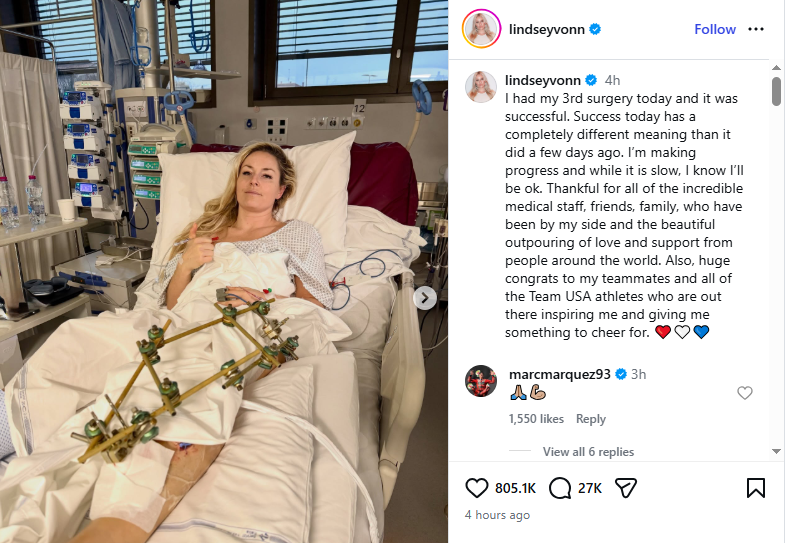 미국 알파인 스키의 '리빙 레전드' 린지 본이 2026 동계올림픽 여자 활강 경기 도중 당한 왼쪽 정강이뼈(경골) 복합 골절 이후 12일(한국시간) 자신의 사회관계망서비스(SNS) 인스타그램 게시글로 근황을 전했다. 본은 게시물에서 '나는 회복 중이고, 속도는 느리지만 결국 괜찮아질 거라는 걸 안다'며 재활 의지를 숨기지 않았다. 또 '곁을 지켜준 의료진, 친구, 가족, 그리고 전 세계에서 보내준 사랑과 응원에 감사하다. 나에게 응원할 무언가를 주는 대표팀 동료들과 미국 선수들에게도 큰 축하를 보낸다'고 적었다. 린지 본 SNS