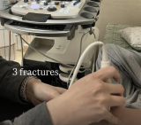 최가온, 손바닥뼈 3곳이 부러졌다…골절상 딛고 한국 첫 설상 金메달 '쾌거' [2026 파리]