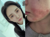 권민아, 의료 사고 후 남은 얼굴 흉터…1억 손해 주장, "솔직히 많이 무섭다"