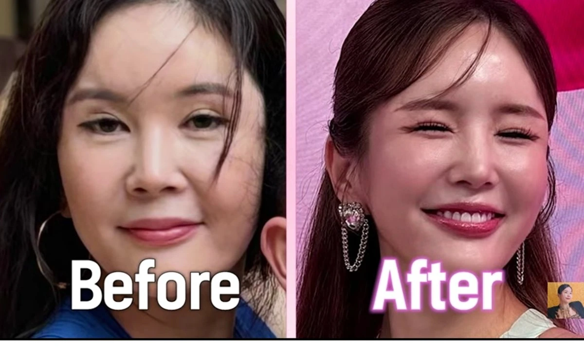 방송인 장영란이 예뻐진 비결을 밝히며 '성형 미인'임을 부정했다.