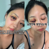 10기 옥순, 시퍼렇게 멍든 눈에 '♥유현철 폭행설' 충격…결국 입장 밝혔다